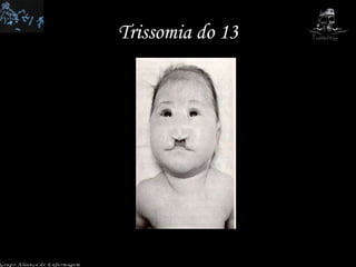 Trissomia do 13 Grupo Aliança de Enfermagem 