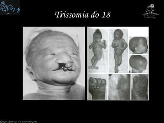 Trissomia do 18 Grupo Aliança de Enfermagem 