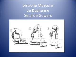 Distrofia Muscular de Duchenne Sinal de Gowers 