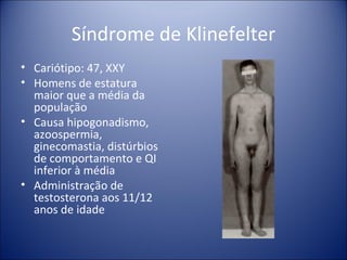 Síndrome de Klinefelter Cariótipo: 47, XXY Homens de estatura maior que a média da população Causa hipogonadismo, azoospermia, ginecomastia, distúrbios de comportamento e QI inferior à média Administração de testosterona aos 11/12 anos de idade 