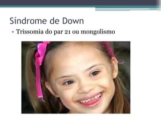 Síndrome de Down
• Trissomia do par 21 ou mongolismo
 