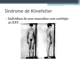 Síndrome de Klinefelter
• Indivíduos do sexo masculino com cariótipo
  47,XXY.
 