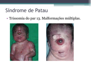 Síndrome de Patau
• Trissomia do par 13. Malformações múltiplas.
 