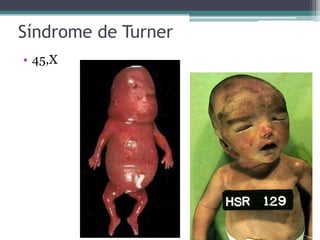 Síndrome de Turner
• 45,X
 