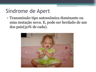 Síndrome de Apert
• Transmissão tipo autossômica dominante ou
  uma mutação nova. E, pode ser herdado de um
  dos pais(50% de cada).
 
