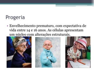 Progeria
• Envelhecimento prematuro, com expectativa de
  vida entre 14 e 16 anos. As células apresentam
  um núcleo com alterações estruturais.
 