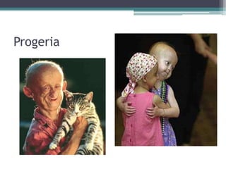 Progeria
 