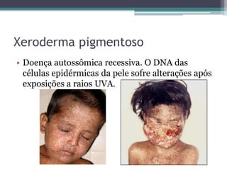 Xeroderma pigmentoso
• Doença autossômica recessiva. O DNA das
  células epidérmicas da pele sofre alterações após
  exposições a raios UVA.
 