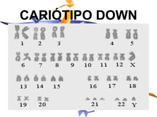 CARIÓTIPO DOWN
 