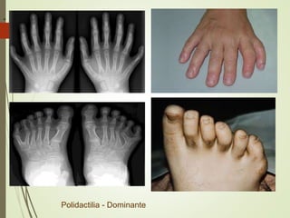 Polidactilia - Dominante
.
 