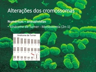 Alterações dos cromossomas
Numéricas – aneuploidias
• Síndrome de Turner - Monossomia (2n-1)
 
