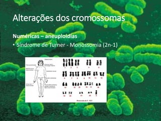 Alterações dos cromossomas
Numéricas – aneuploidias
• Síndrome de Turner - Monossomia (2n-1)
 
