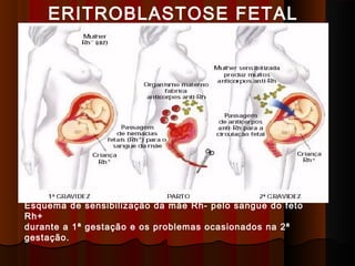 ERITROBLASTOSE FETAL
Esquema de sensibilização da mãe Rh- pelo sangue do feto
Rh+
durante a 1ª gestação e os problemas ocasionados na 2ª
gestação.
 
