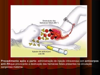 Procedimento após o parto: administração de injeção intravenosa com anticorpos
anti-Rhque provocarão a destruição das hemácias fetais presentes na circulação
sangüínea materna.
 