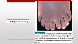 Mutação em HOXD13
 