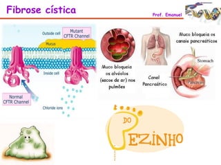Fibrose cística Prof. Emanuel
 