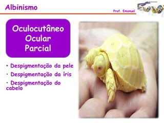 • Despigmentação da pele
• Despigmentação da íris
• Despigmentação do
cabelo
Albinismo Prof. Emanuel
Oculocutâneo
Ocular
Parcial
 