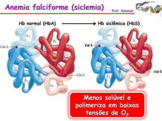 Menos solúvel e
polimeriza em baixas
tensões de O2
Hb normal (HbA) Hb siclêmica (HbS)
Anemia falciforme (siclemia) Prof. Emanuel
 