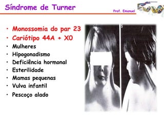 • Monossomia do par 23
• Cariótipo 44A + X0
• Mulheres
• Hipogonadismo
• Deficiência hormonal
• Esterilidade
• Mamas pequenas
• Vulva infantil
• Pescoço alado
Síndrome de Turner Prof. Emanuel
 