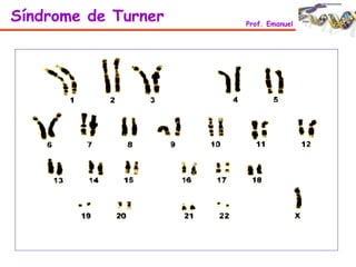Síndrome de Turner Prof. Emanuel
 