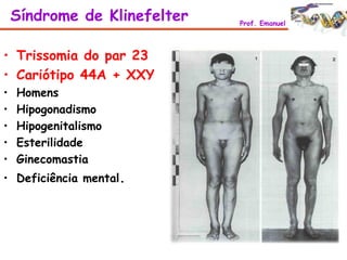 • Trissomia do par 23
• Cariótipo 44A + XXY
• Homens
• Hipogonadismo
• Hipogenitalismo
• Esterilidade
• Ginecomastia
• Deficiência mental.
Síndrome de Klinefelter Prof. Emanuel
 