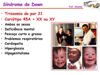• Trissomia do par 21
• Cariótipo 45A + XX ou XY
• Ambos os sexos
• Deficiência mental
• Pescoço curto e grosso
• Problemas respiratórios
• Cardiopatia
• Hiperglossia
• Hipogenitalismo
Síndrome de Down Prof. Emanuel
 