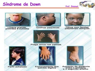 Síndrome de Down Prof. Emanuel
 