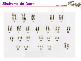 Síndrome de Down Prof. Emanuel
 