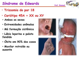 • Trissomia do par 18
• Cariótipo 45A + XX ou XY
• Ambos os sexos
• Extremidades anômalas
• Má formação sistêmica
• Lábio leporino e palato
fendido
• Óbito em 90% dos casos
• Maxilar retraído ou
ausente
Síndrome de Edwards Prof. Emanuel
 