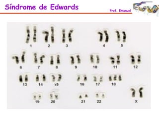 Síndrome de Edwards Prof. Emanuel
 