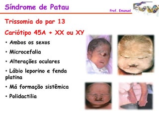 Trissomia do par 13
Cariótipo 45A + XX ou XY
• Ambos os sexos
• Microcefalia
• Alterações oculares
• Lábio leporino e fenda
platina
• Má formação sistêmica
• Polidactilia
Síndrome de Patau Prof. Emanuel
 