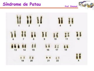 Síndrome de Patau Prof. Emanuel
 