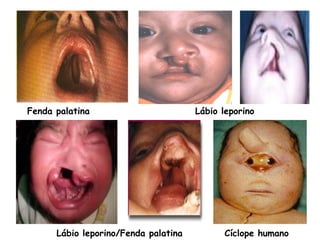 Fenda palatina Lábio leporino
Cíclope humanoLábio leporino/Fenda palatina
 