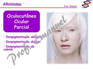 • Despigmentação da pele
• Despigmentação da íris
• Despigmentação do
cabelo
Albinismo Prof. Emanuel
Oculocutâneo
Ocular
Parcial
 