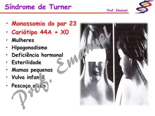 • Monossomia do par 23
• Cariótipo 44A + X0
• Mulheres
• Hipogonadismo
• Deficiência hormonal
• Esterilidade
• Mamas pequenas
• Vulva infantil
• Pescoço alado
Síndrome de Turner Prof. Emanuel
 