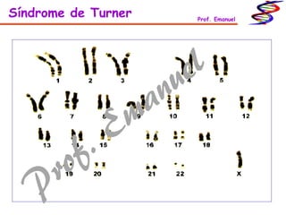 Síndrome de Turner Prof. Emanuel
 