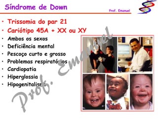 • Trissomia do par 21
• Cariótipo 45A + XX ou XY
• Ambos os sexos
• Deficiência mental
• Pescoço curto e grosso
• Problemas respiratórios
• Cardiopatia
• Hiperglossia
• Hipogenitalismo
Síndrome de Down Prof. Emanuel
 