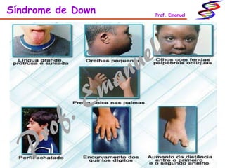 Síndrome de Down Prof. Emanuel
 