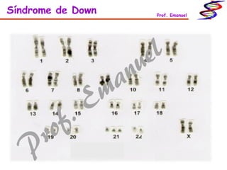 Síndrome de Down Prof. Emanuel
 