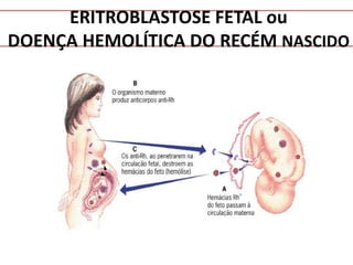 ERITROBLASTOSE FETAL ou
DOENÇA HEMOLÍTICA DO RECÉM NASCIDO
 