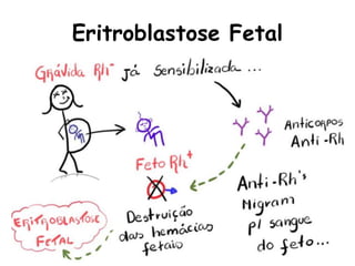 Eritroblastose Fetal
 