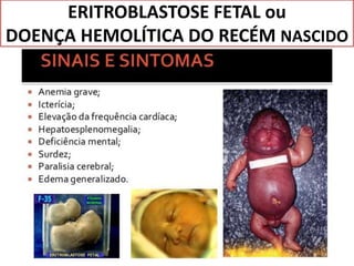 ERITROBLASTOSE FETAL ou
DOENÇA HEMOLÍTICA DO RECÉM NASCIDO
 
