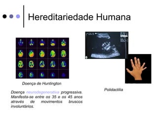 Hereditariedade Humana 
Doença de Huntington 
Doença neurodegenerativa progressiva. Polidactilia 
Manifesta-se entre os 35...