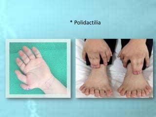 * Polidactilia
 