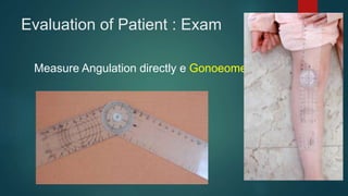 Evaluation of Patient : Exam
Measure Angulation directly e Gonoeometer
 