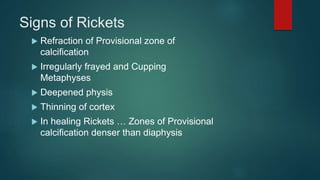 Signs of Rickets
 Refraction of Provisional zone of
calcification
 Irregularly frayed and Cupping
Metaphyses
 Deepened physis
 Thinning of cortex
 In healing Rickets … Zones of Provisional
calcification denser than diaphysis
 