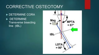 CORRECTIVE OSTEOTOMY
 DETERMINE CORA
 DETERMINE
Transverse bisecting
line (tBL)
 