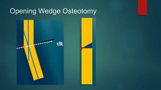 Opening Wedge Osteotomy
 