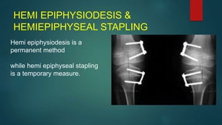 HEMI EPIPHYSIODESIS &
HEMIEPIPHYSEAL STAPLING
Hemi epiphysiodesis is a
permanent method
while hemi epiphyseal stapling
is a temporary measure.
 