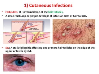 1) Cutaneous Infections
• Folliculitis: It is inflammation of the hair follicles.
• A small red bump or pimple develops at infection sites of hair follicle.
• Sty: A sty is folliculitis affecting one or more hair follicles on the edge of the
upper or lower eyelid.
 